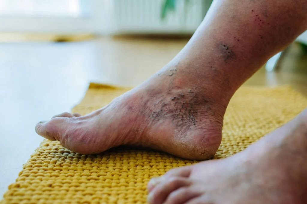 Peripheral Neuropathy Explained: Causes, Symptoms, and Relief Strategies